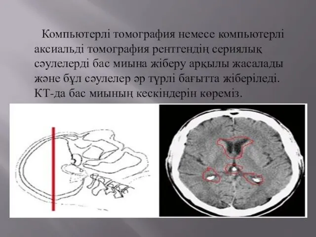 Компьютерлі томография немесе компьютерлі аксиальді томография рентгендің сериялық сәулелерді бас