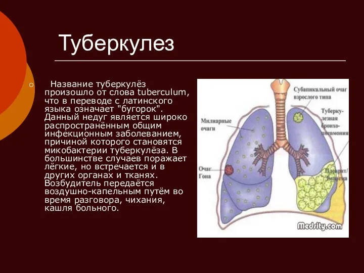 Туберкулез Название туберкулёз произошло от слова tuberculum, что в переводе