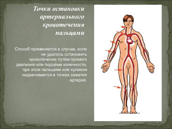 Точки остановки артериального кровотечения пальцами Способ применяется в случае, если