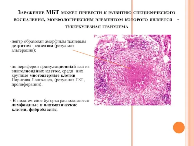 Заражение МБТ может привести к развитию специфического воспаления, морфологическим элементом