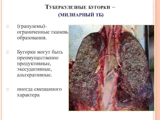 Туберкулезные бугорки – (МИЛИАРНЫЙ ТБ) (гранулемы)- ограниченные тканевые образования. Бугорки