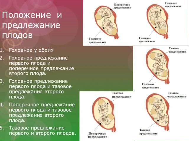 Положение и предлежание плодов Головное у обоих Головное предлежание первого