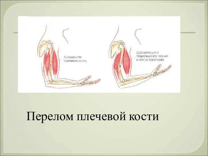 Перелом плечевой кости