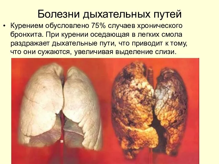 Болезни дыхательных путей Курением обусловлено 75% случаев хронического бронхита. При