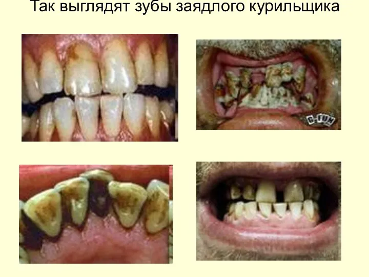 Так выглядят зубы заядлого курильщика