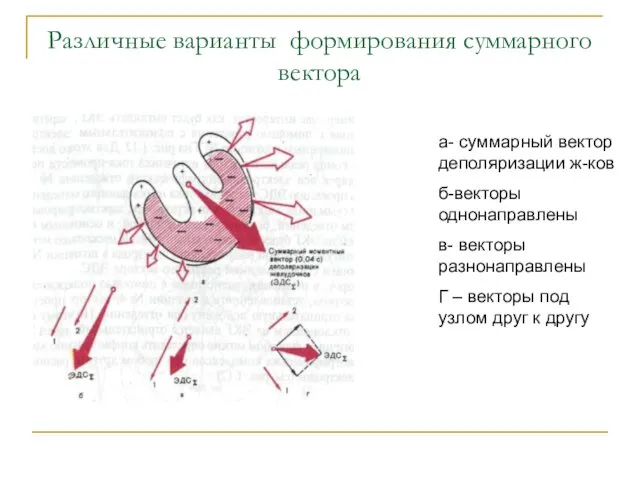 Различные варианты формирования суммарного вектора а- суммарный вектор деполяризации ж-ков