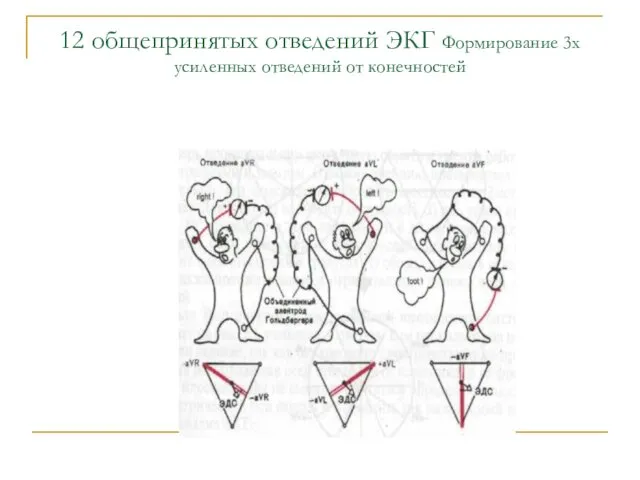 12 общепринятых отведений ЭКГ Формирование 3х усиленных отведений от конечностей