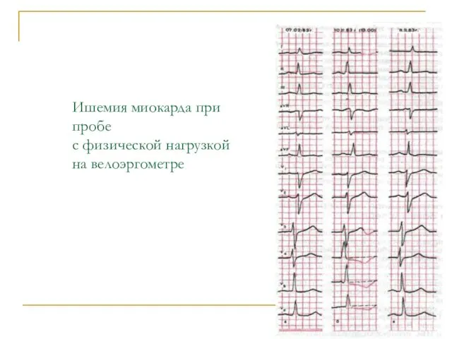 Ишемия миокарда при пробе с физической нагрузкой на велоэргометре