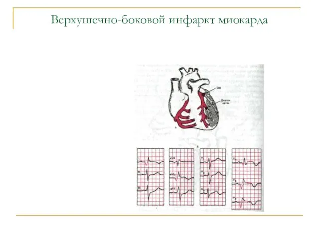 Верхушечно-боковой инфаркт миокарда