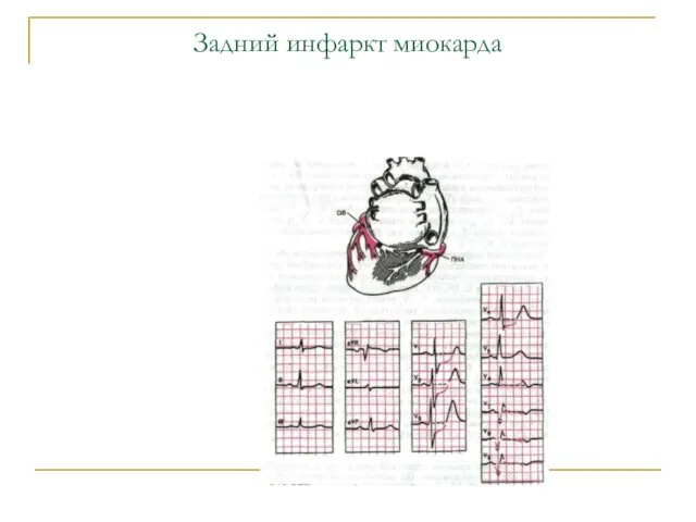 Задний инфаркт миокарда