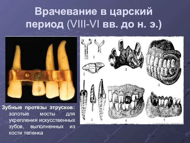 Врачевание в царский период (VIII-VI вв. до н. э.) Зубные протезы этрусков: золотые
