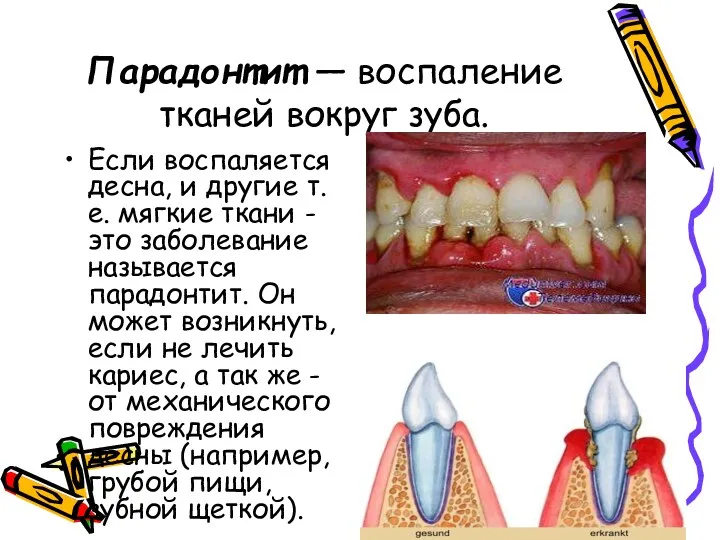 Парадонтит — воспаление тканей вокруг зуба. Если воспаляется десна, и другие т.е. мягкие