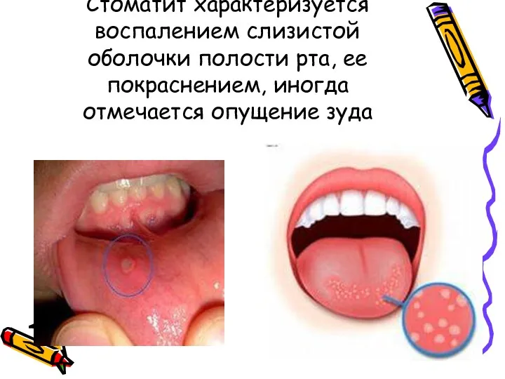 Стоматит характеризуется воспалением слизистой оболочки полости рта, ее покраснением, иногда отмечается опущение зуда