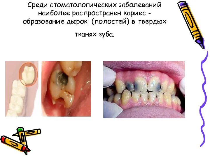 Среди стоматологических заболеваний наиболее распространен кариес - образование дырок (полостей) в твердых тканях зуба.