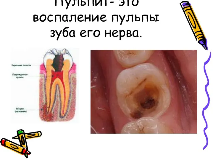 Пульпит- это воспаление пульпы зуба его нерва.