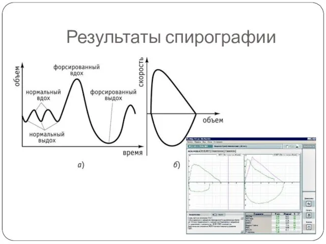 Результаты спирографии