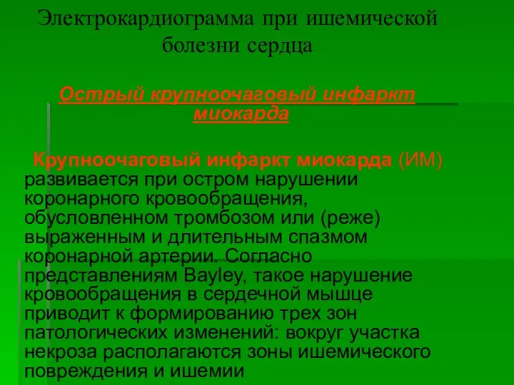 Электрокардиограмма при ишемической болезни сердца Острый крупноочаговый инфаркт миокарда Крупноочаговый инфаркт миокарда (ИМ)