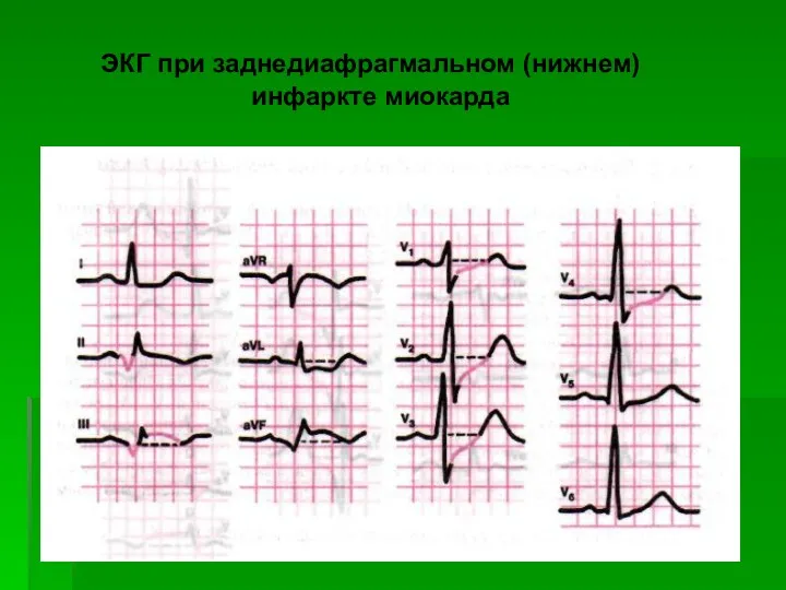ЭКГ при заднедиафрагмальном (нижнем) инфаркте миокарда
