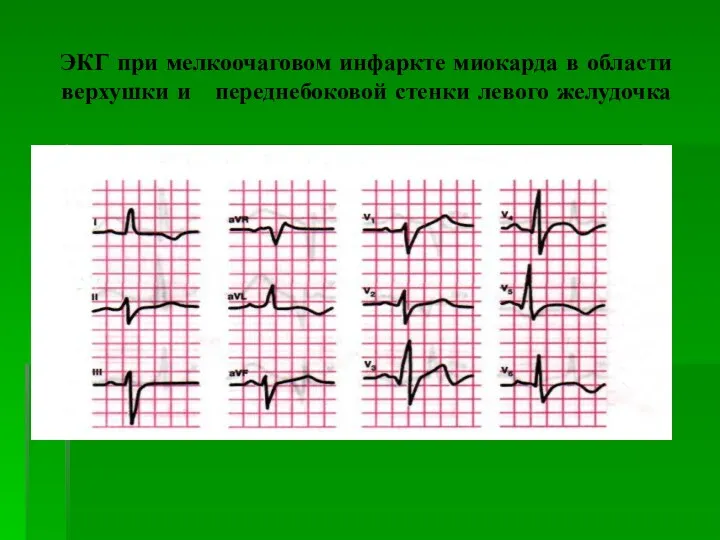 ЭКГ при мелкоочаговом инфаркте миокарда в области верхушки и переднебоковой стенки левого желудочка