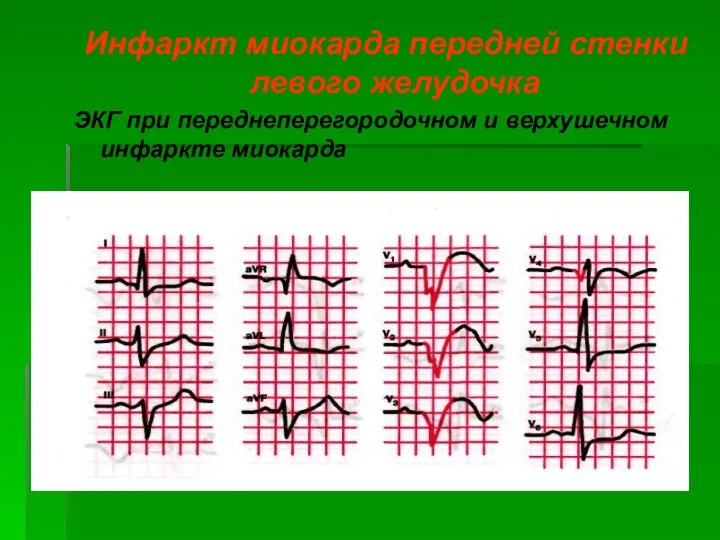 Инфаркт миокарда передней стенки левого желудочка ЭКГ при переднеперегородочном и верхушечном инфаркте миокарда