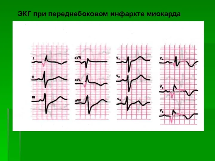 ЭКГ при переднебоковом инфаркте миокарда
