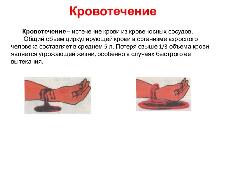 Кровотечение Кровотечение – истечение крови из кровеносных сосудов. Общий объем