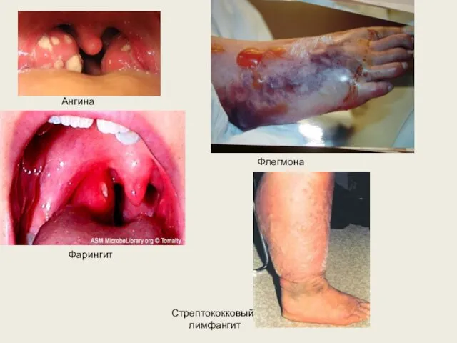 Фарингит Ангина Флегмона Стрептококковый лимфангит