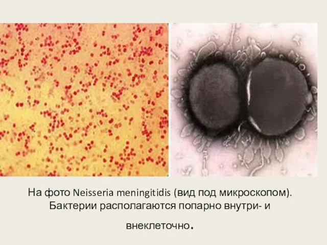 На фото Neisseria meningitidis (вид под микроскопом). Бактерии располагаются попарно внутри- и внеклеточно.