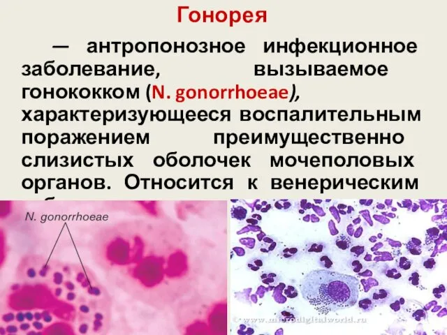 Гонорея — антропонозное инфекционное заболевание, вызываемое гонококком (N. gonorrhoeae), характеризующееся воспалительным поражением преимущественно