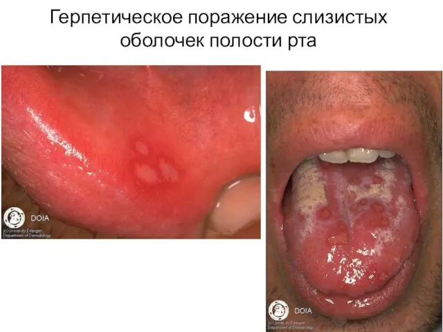 Герпетическое поражение слизистых оболочек полости рта