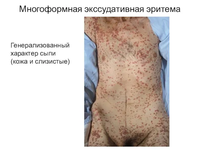 Многоформная экссудативная эритема Генерализованный характер сыпи (кожа и слизистые)