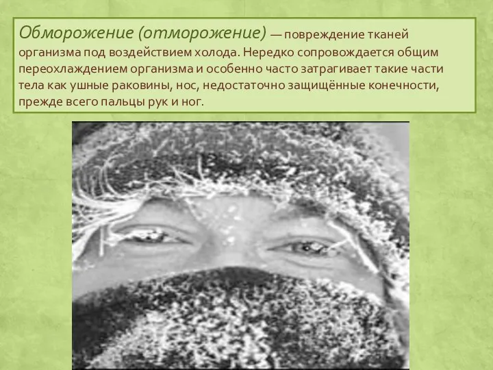 Обморожение (отморожение) — повреждение тканей организма под воздействием холода. Нередко сопровождается общим переохлаждением