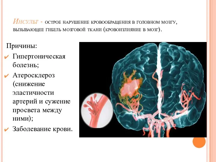 Инсульт - острое нарушение кровообращения в головном мозгу, вызывающее гибель мозговой ткани (кровоизлияние