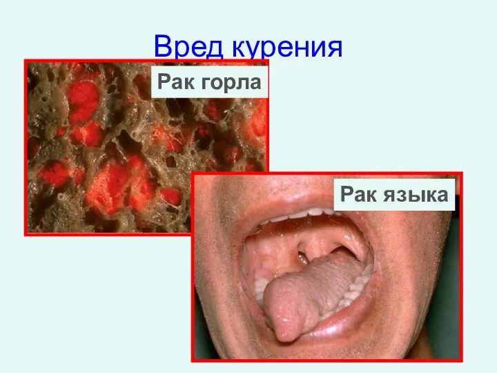 Вред курения Рак горла Рак языка