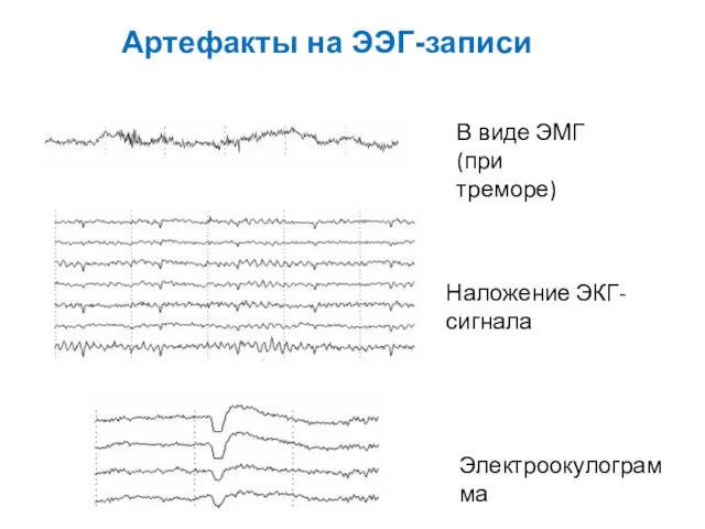 Артефакты на ЭЭГ-записи В виде ЭМГ (при треморе) Наложение ЭКГ-сигнала Электроокулограмма