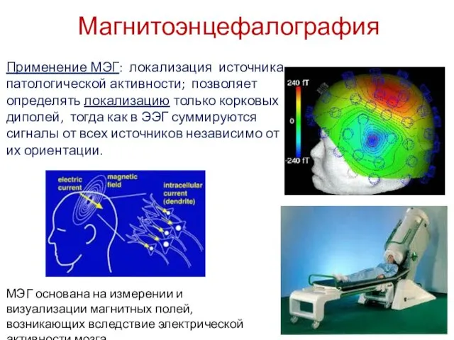 Магнитоэнцефалография Применение МЭГ: локализация источника патологической активности; позволяет определять локализацию