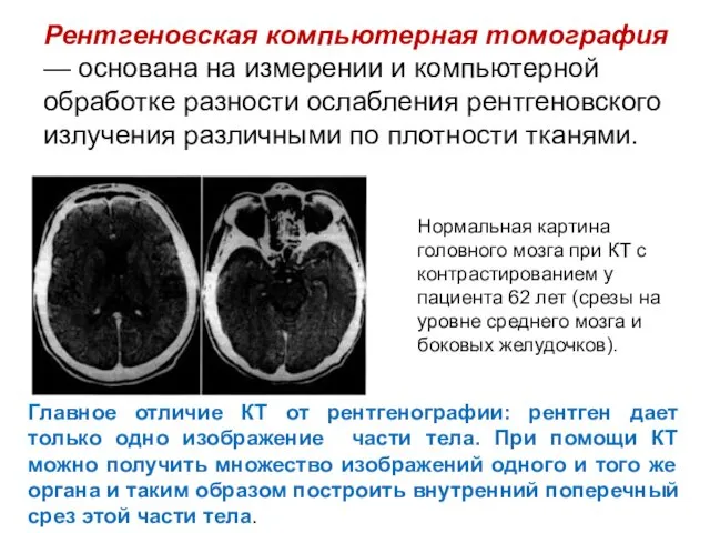 Рентгеновская компьютерная томография — основана на измерении и компьютерной обработке