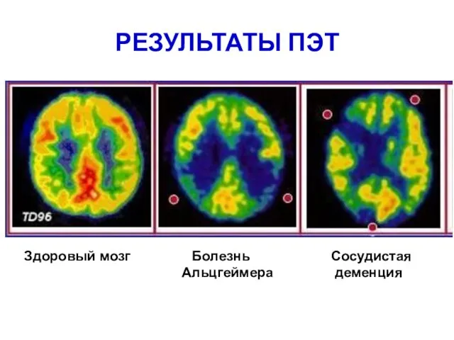 РЕЗУЛЬТАТЫ ПЭТ Здоровый мозг Болезнь Сосудистая Альцгеймера деменция