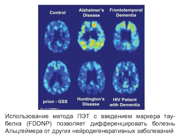 Использование метода ПЭТ с введением маркера тау-белка (FDDNP) позволяет дифференцировать болезнь Альцгеймера от других нейродегенеративных заболеваний