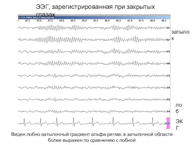 затылок лоб ЭКГ ЭЭГ, зарегистрированная при закрытых глазах Виден лобно-затылочный