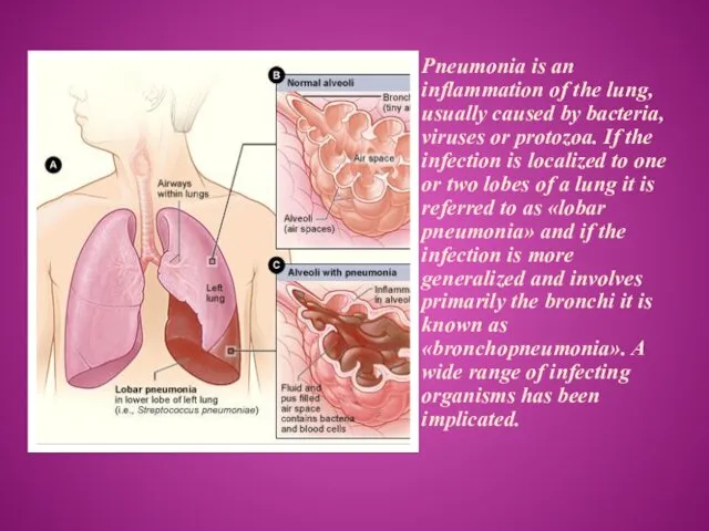 Pneumonia is an inflammation of the lung, usually caused by bacteria, viruses or