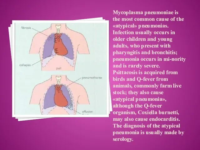 Mycoplasma pneumoniae is the most common cause of the «atypical» pneumonias. Infection usually