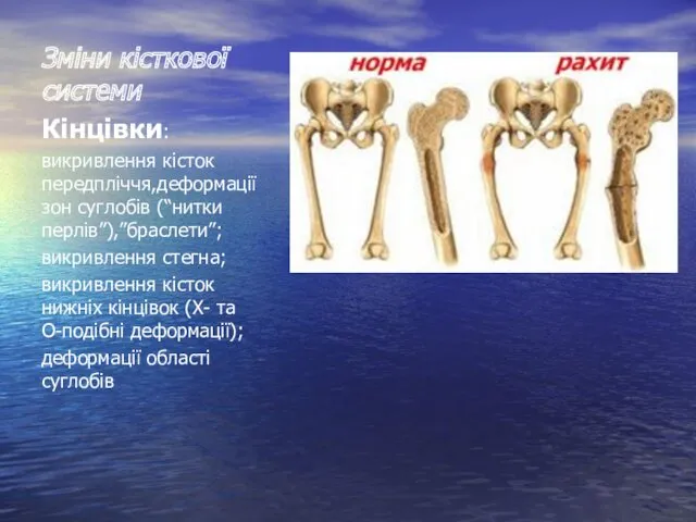 Зміни кісткової системи Кінцівки: викривлення кісток передпліччя,деформації зон суглобів (“нитки перлів”),”браслети”; викривлення стегна;