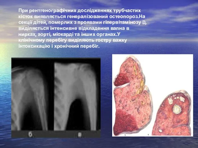 При рентгенографічних дослідженнях трубчастих кісток виявляється генералізований остеопороз.На секції дітей,