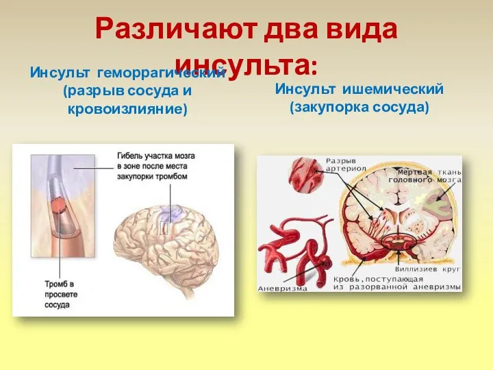 Различают два вида инсульта: Инсульт геморрагический (разрыв сосуда и кровоизлияние) Инсульт ишемический (закупорка сосуда)