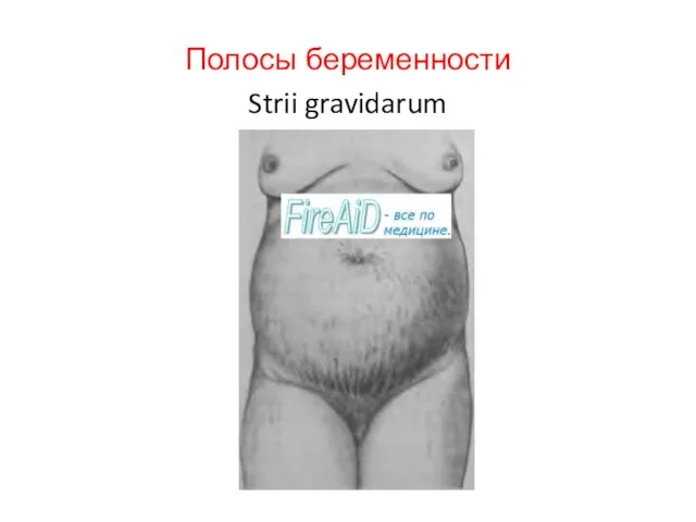 Полосы беременности Strii gravidarum