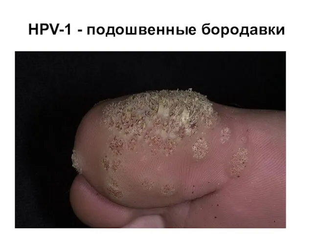 HPV-1 - подошвенные бородавки