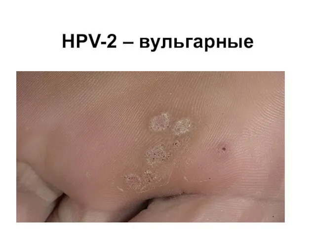 HPV-2 – вульгарные