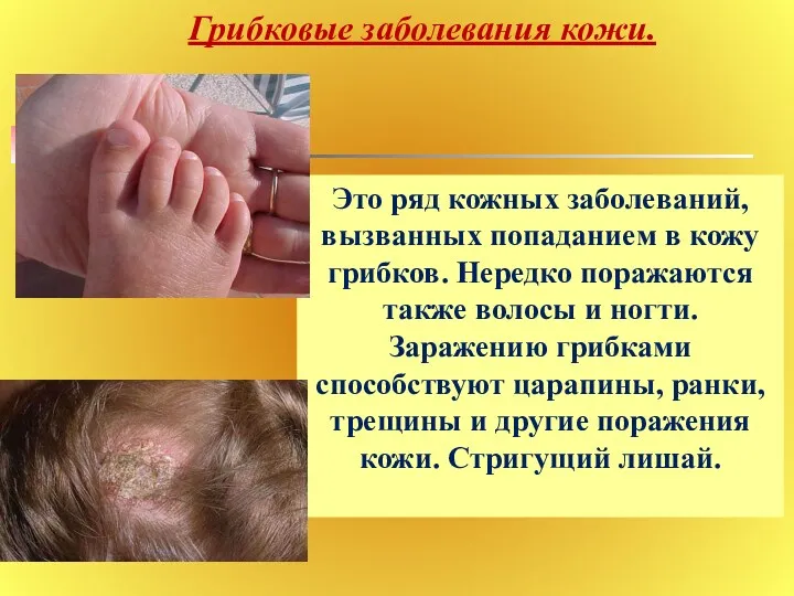 Грибковые заболевания кожи. Это ряд кожных заболеваний, вызванных попаданием в
