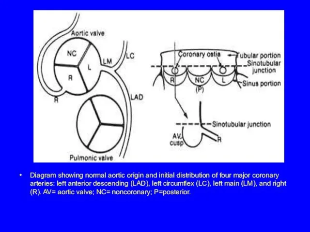 Diagram showing normal aortic origin and initial distribution of four